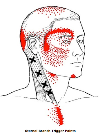 Sternal Branch Trigger Points