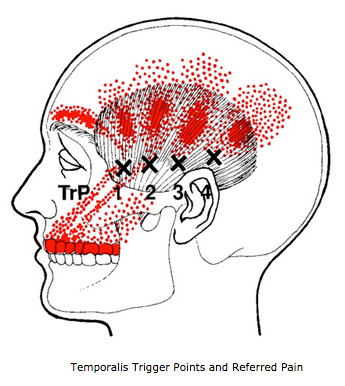 Temporalis Trigger Points and Referred Pain