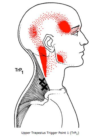 Upper Trapezius Trigger Points